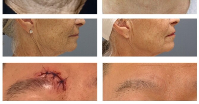 Pixel8 RF Micro-needling